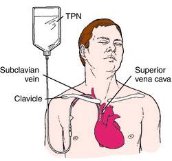 total_parenteral_nu.jpg