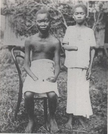Congolese%20amputated%20hands.jpg
