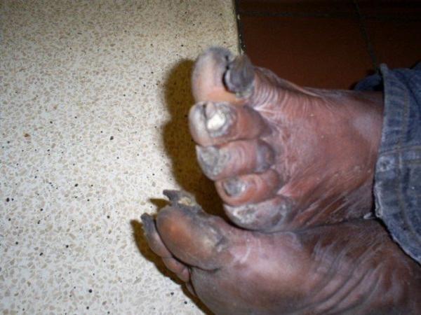 ugly-feet.jpg